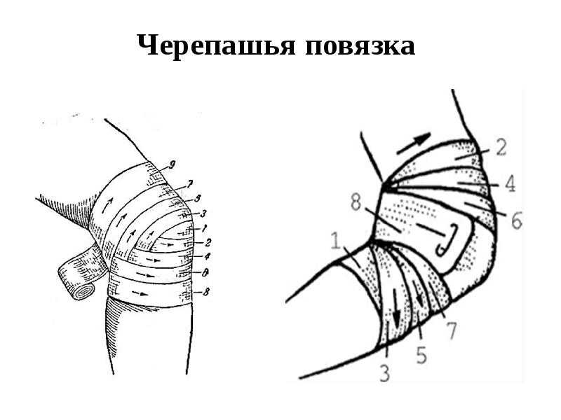 Черепашья повязка на локтевой и коленный суставы: техника наложения :: syl.ru