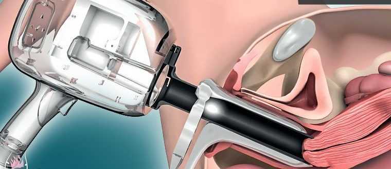 Гинекологические зеркала: размеры, назначение. инструменты врача-гинеколога