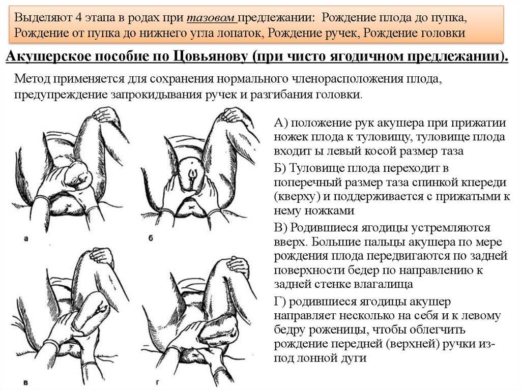 Анализ пособий по цовьянову и брахту при тазовом предлежании » акушерство и гинекология