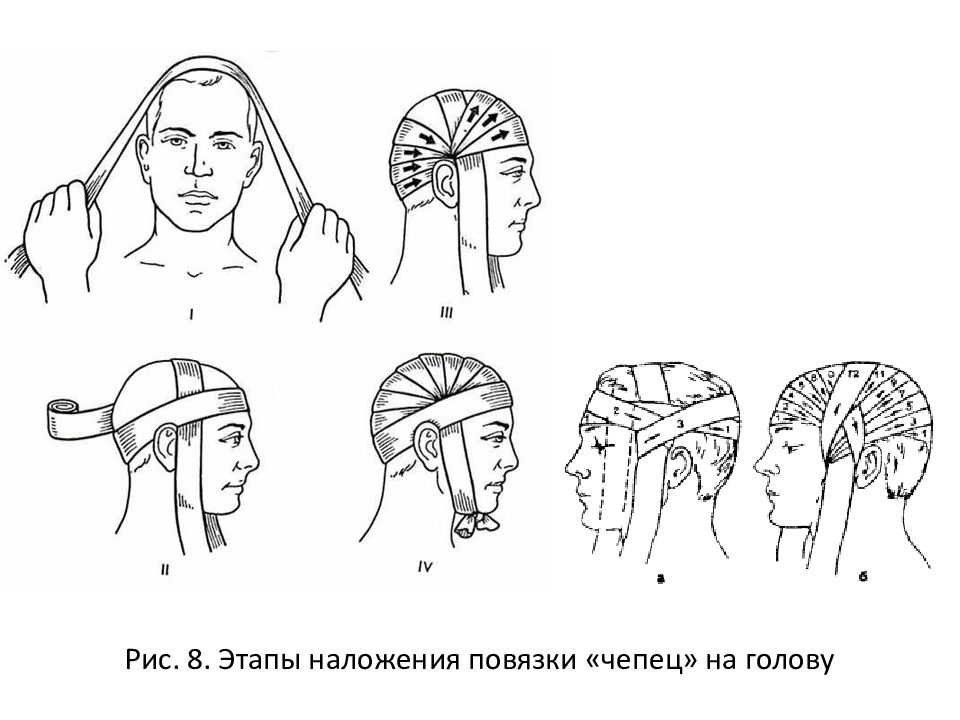 Назначение и правила наложения повязки-чепца
