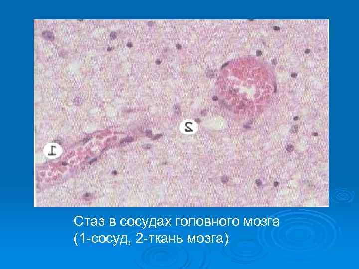Патологическая анатомия: стаз
