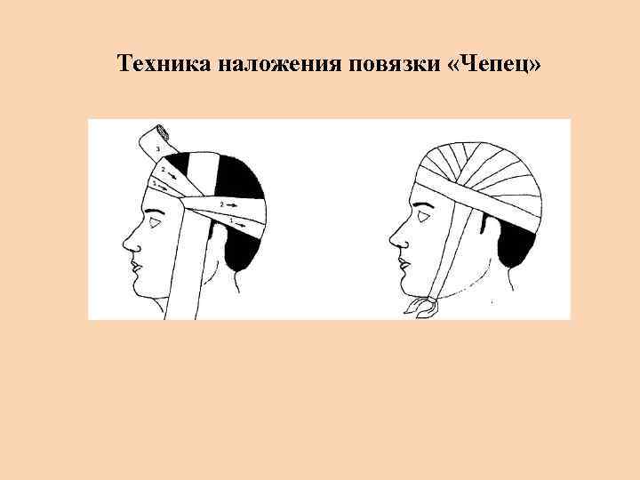Назначение и правила наложения повязки-чепца