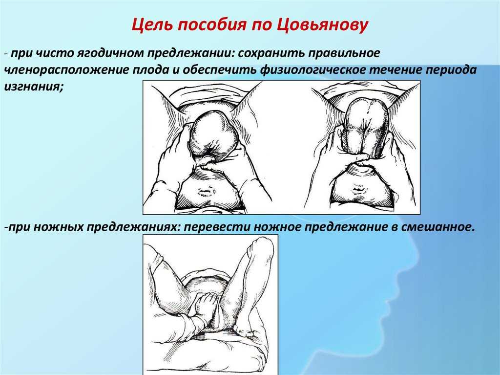 Пособие при тазовом предлежании по цовьянову imother.su- все для будущей мамы