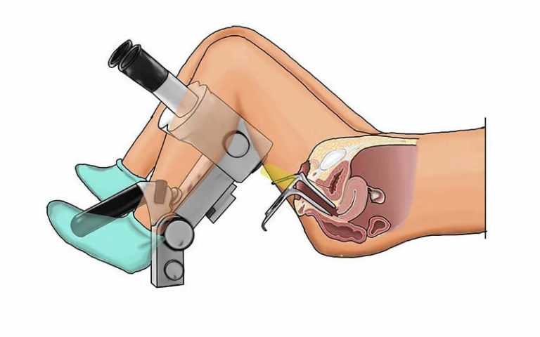 Осмотр шейки матки при помощи зеркал, осмотр при помощи двустворчатого зеркала