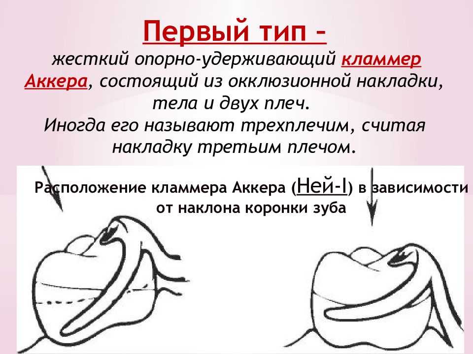 Кламмер виды кламмеров кламмерная система нея • ohi-s