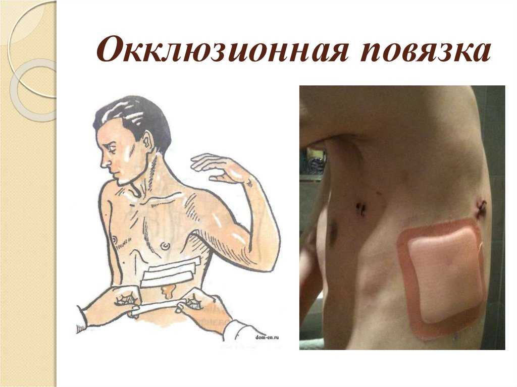 Первая помощь наложение окклюзионной повязки