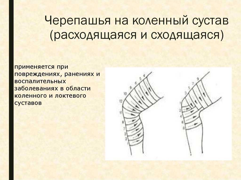 Целесообразность применения и техника наложения черепашьей повязки на локтевой сустав