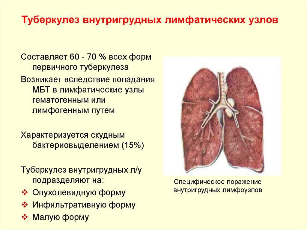 Первичный туберкулезный комплекс