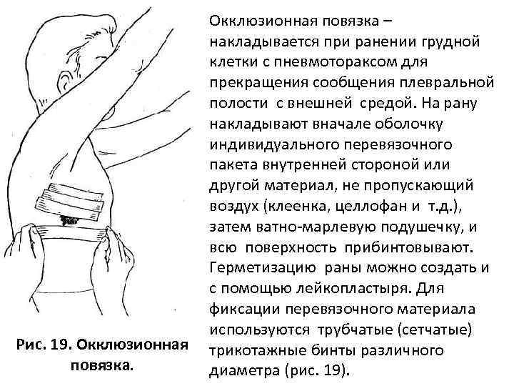 Наложение окклюзионной повязки при открытом пневмотораксе pulmono.ru
наложение окклюзионной повязки при открытом пневмотораксе