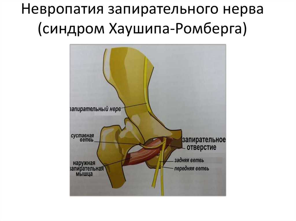 Синдром запирательного канала: причины, симптомы и лечение