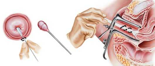 Кольпоскопия простая и расширенная: все подробности обследования