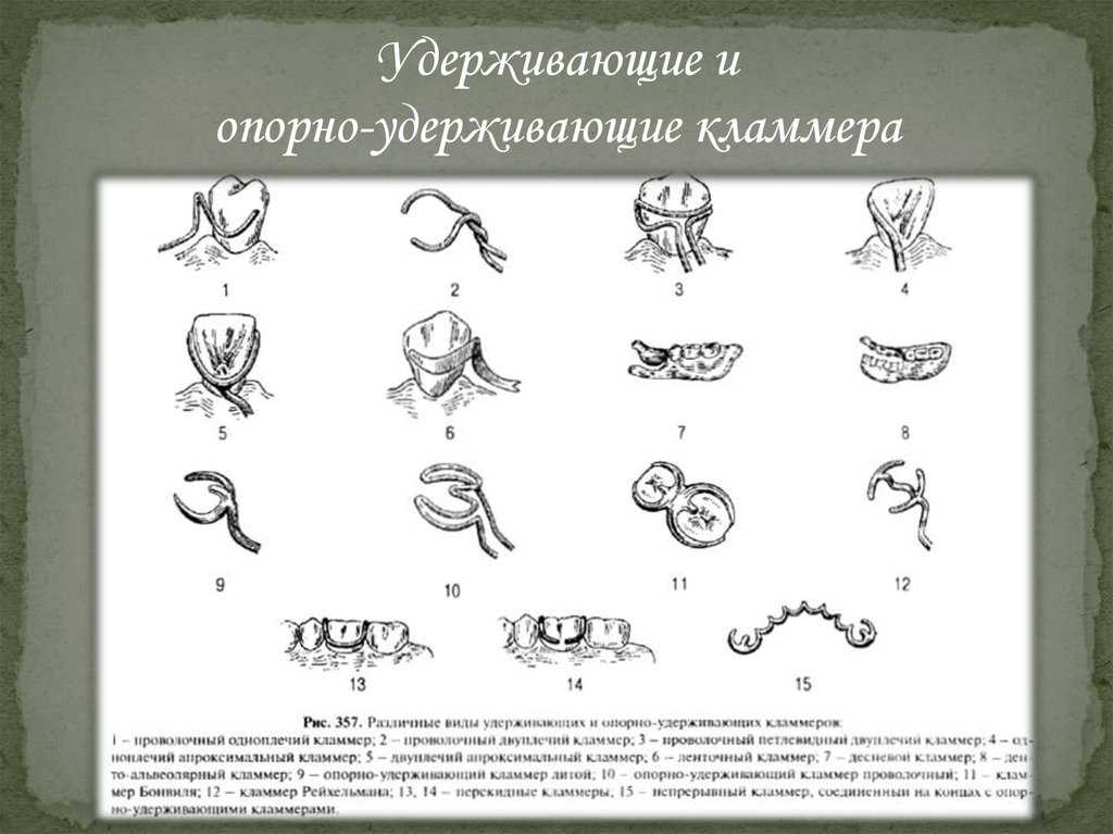 Кламмерная система нея кратко