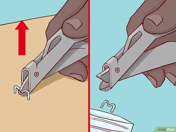 Как снимать швы: 15 шагов (с иллюстрациями) - wikihow