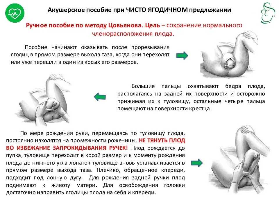 Глава 12. беременность и роды при тазовых предлежаниях плода