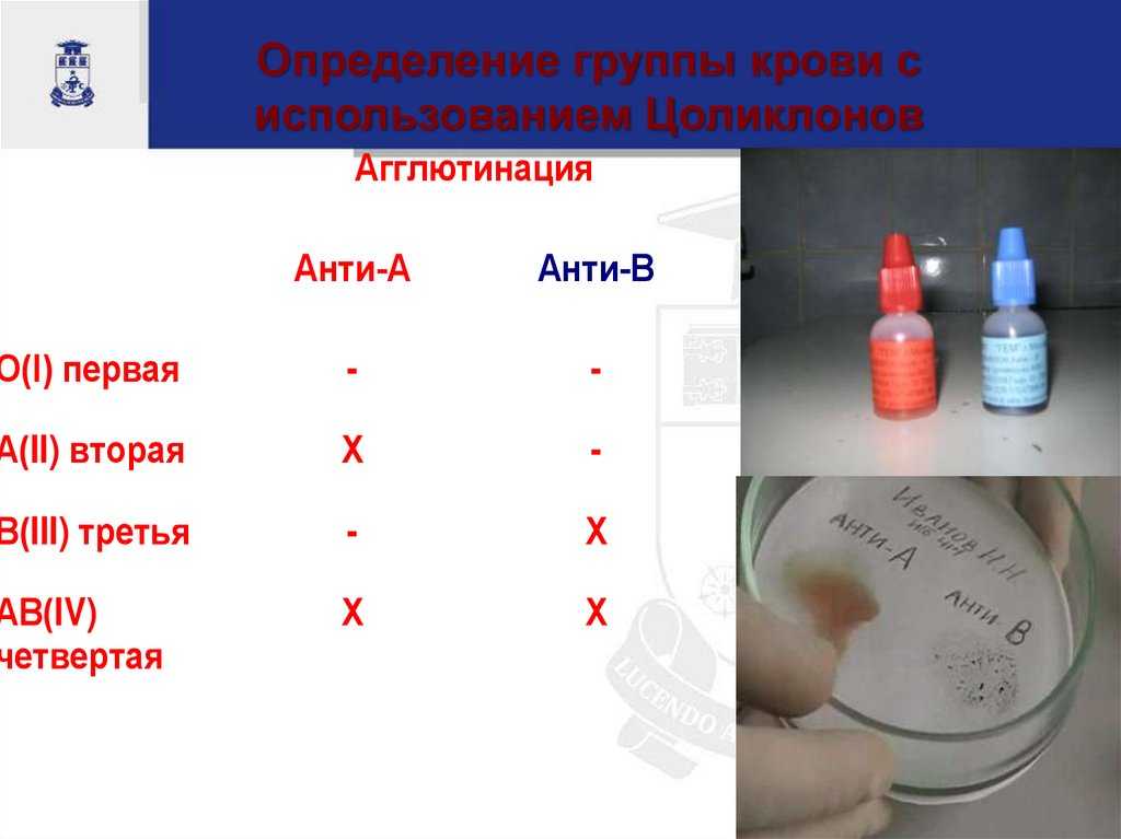 Определение группы крови по цоликлонам: как проводят, расшифровка результатов