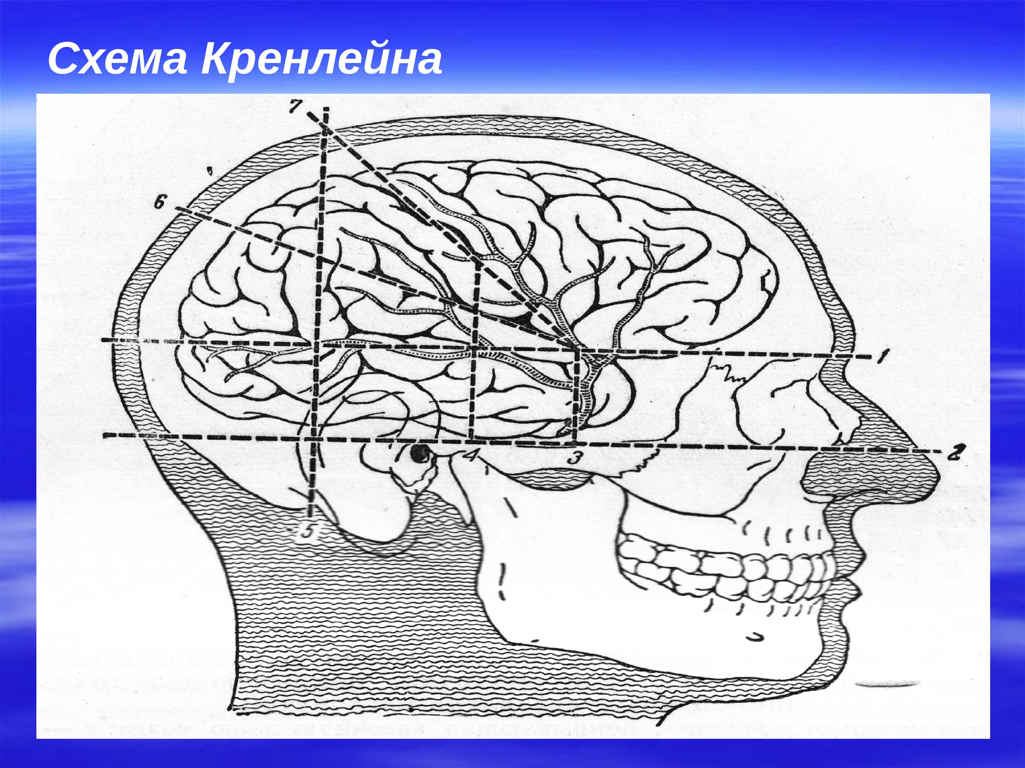 Схема черепно мозговой топографии кренлейна брюсовой