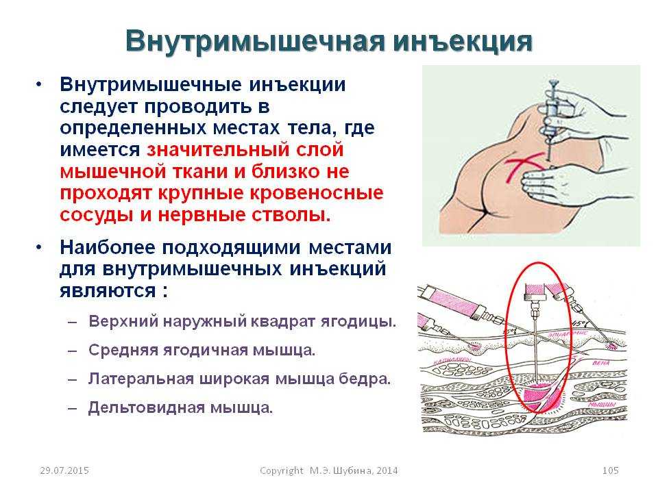 Внутримышечная инъекция: техника, алгоритм, правила, осложнения