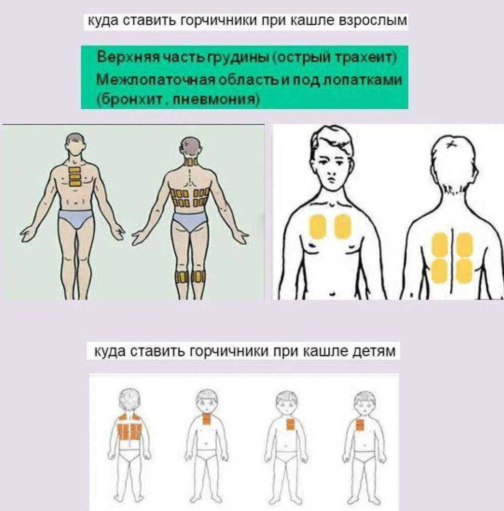 Горчичники при кашле детям: как правильно ставить и с какого возраста