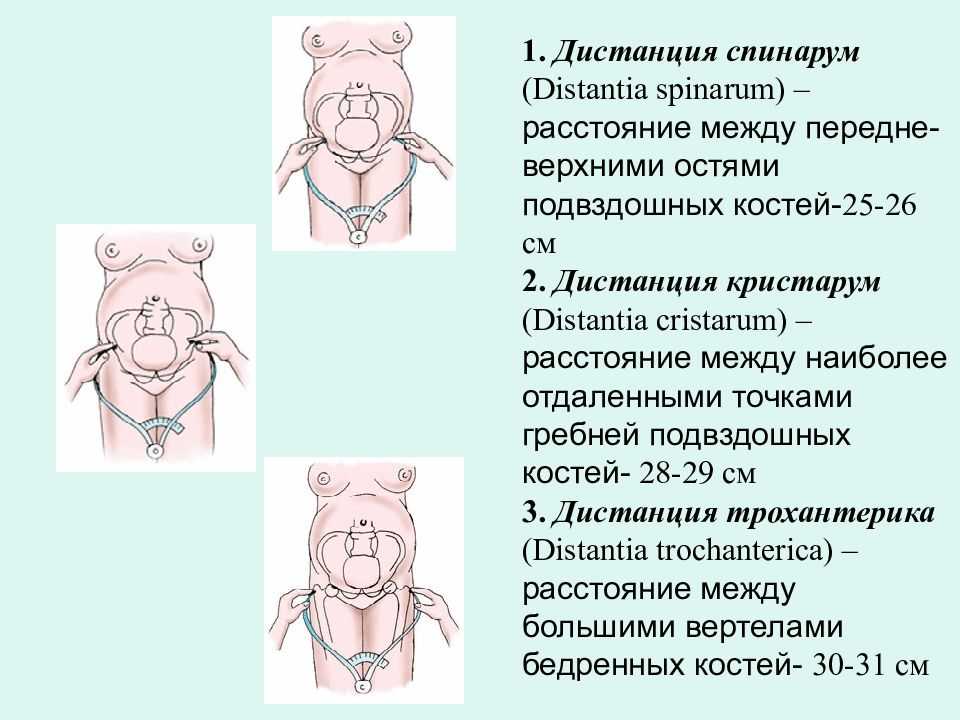 Исследование таза беременной. крестцовый ромб ( ромб михаэлиса ).