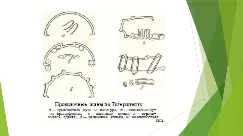 Шинирование при переломе челюсти – сколько носят и как снимают шины