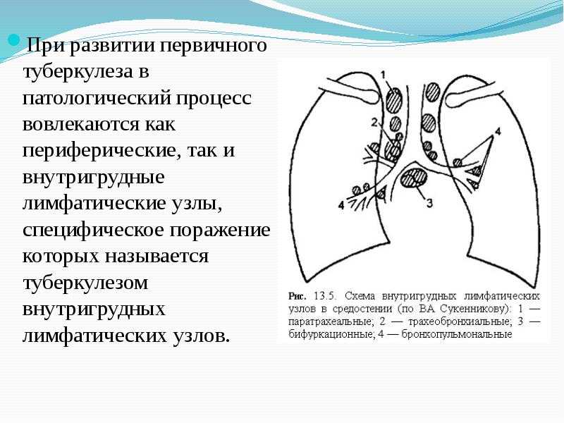 Первичный туберкулезный комплекс. фтизиатрия. справочник