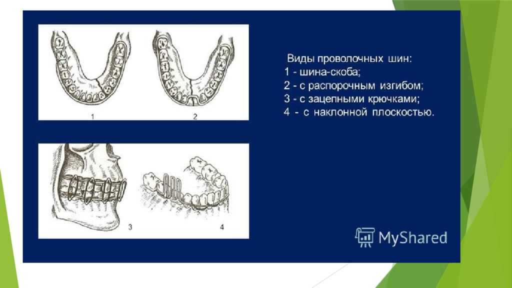 Проволочная шина тигерштедта (фиксатор для челюсти): гладкая, с зацепными петлями