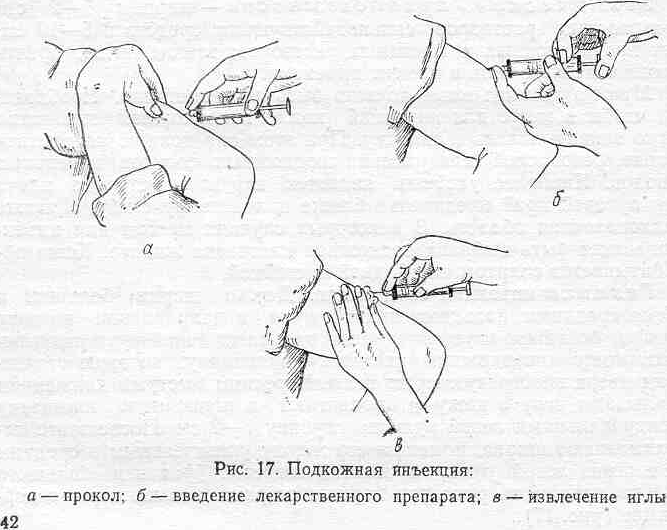 Техника введение лекарственных средств подкожно
