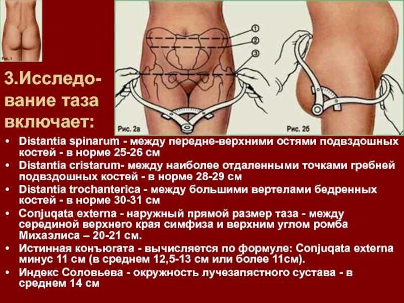 Исследование таза беременной. крестцовый ромб ( ромб михаэлиса ).