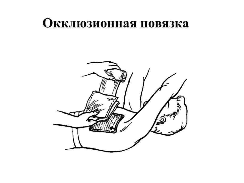 Первая помощь при пневмотораксе: алгоритм действий, виды, особенности