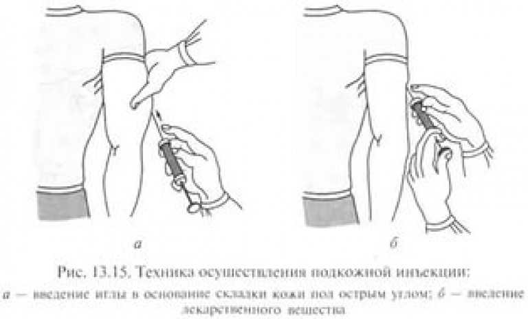 Техника подкожного введения лекарственного препарата