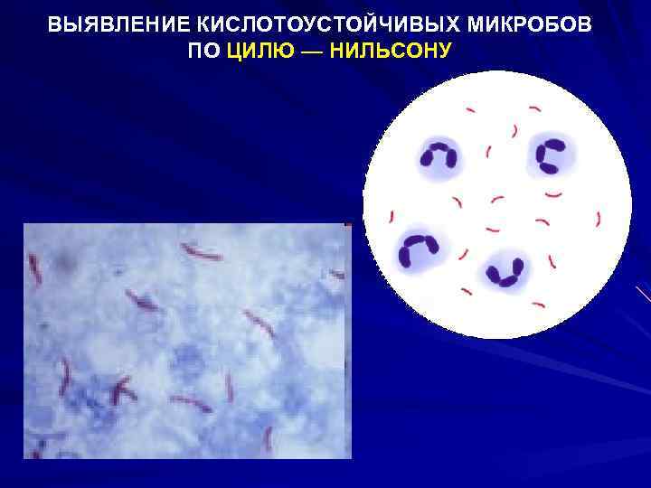 Кислотоустойчивые бактерии по цилю нильсену: метод окраски