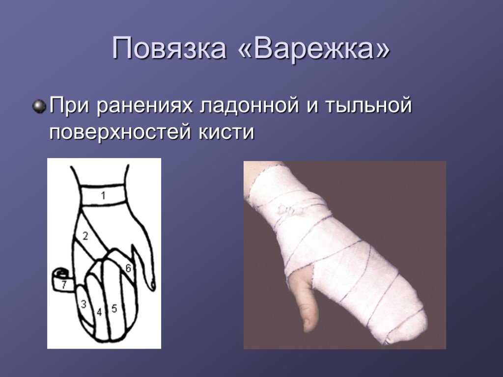 Повязка варежка: показания, виды, техника и алгоритм наложения повязки варежки