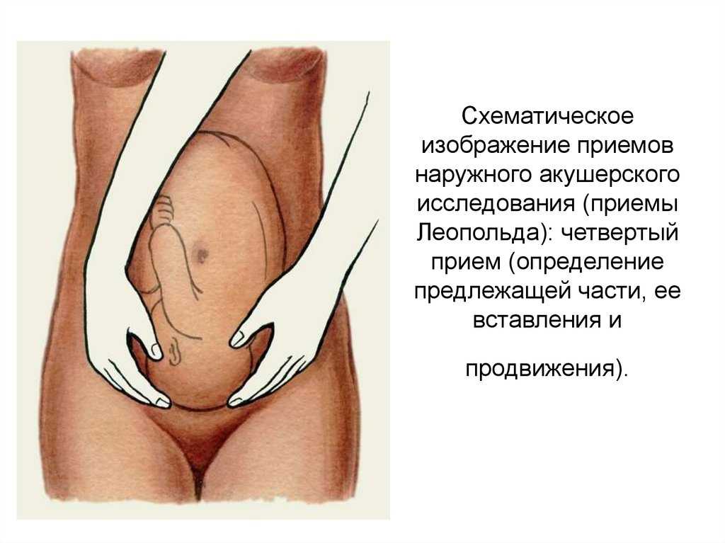 Приемы леопольда левицкого кратко