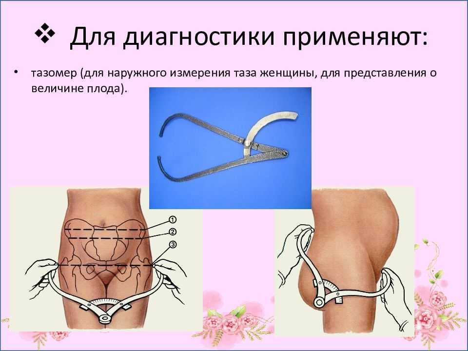 Исследование таза беременной. крестцовый ромб ( ромб михаэлиса ).