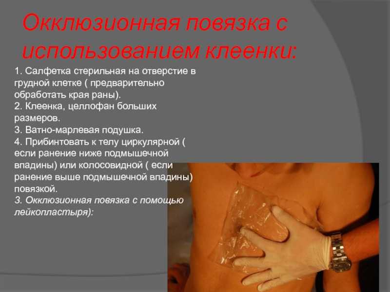 Как выполняют наложение окклюзионной повязки на грудную клетку при открытом пневмотораксе? - medboli.ru